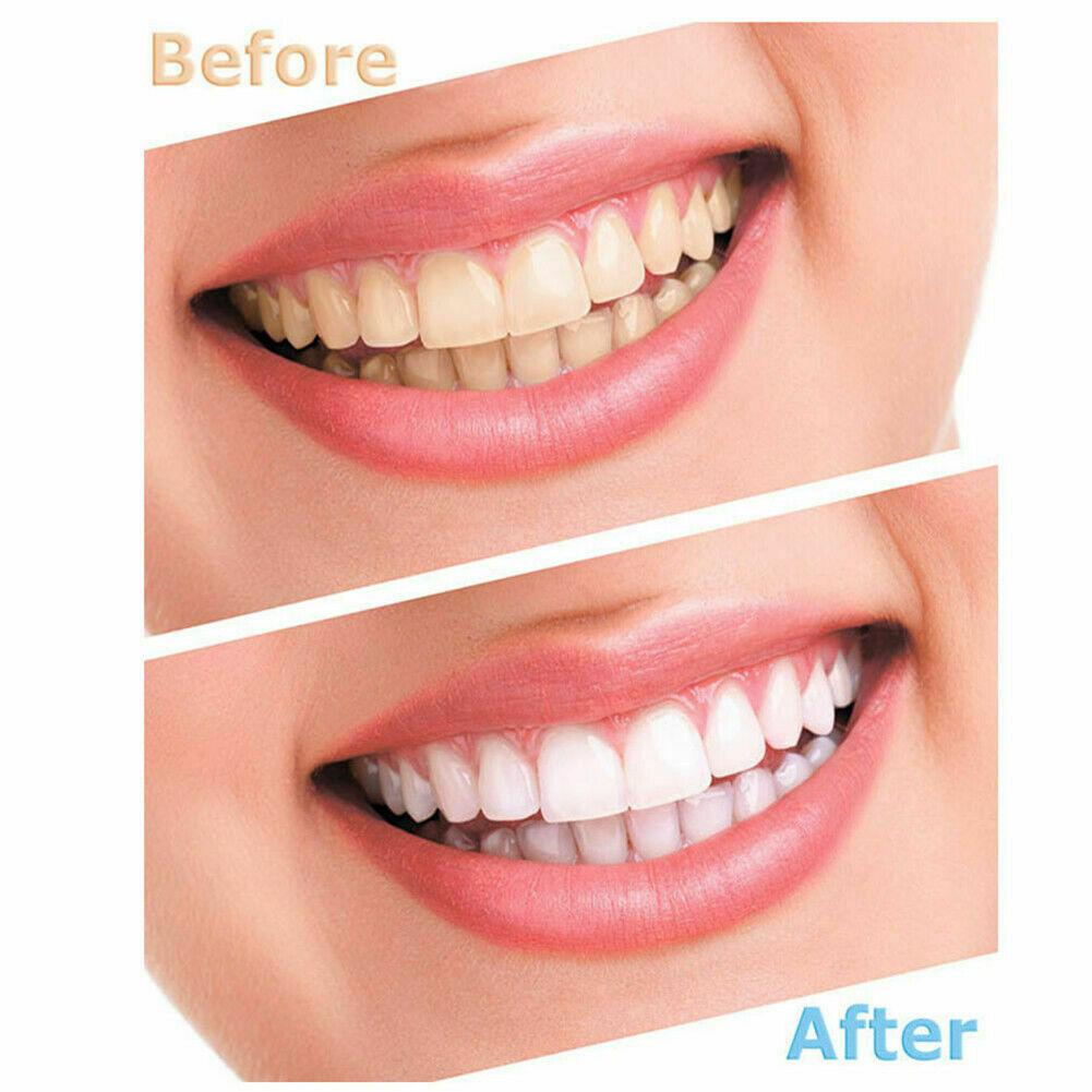 Teeth Whitening Kit 2